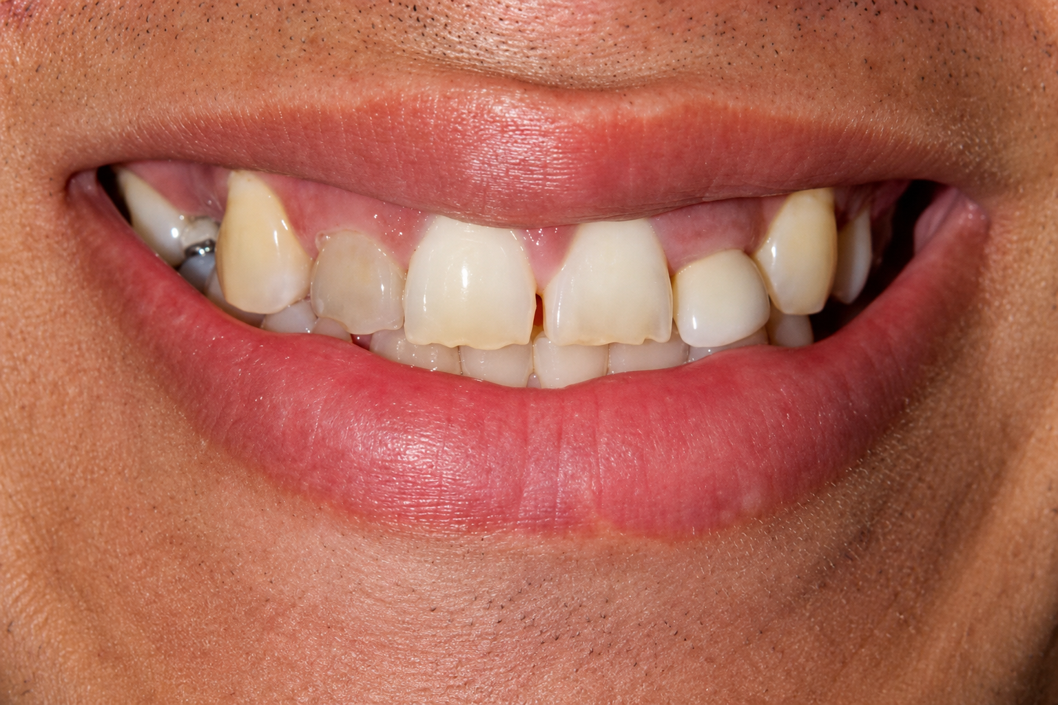 After Treatment